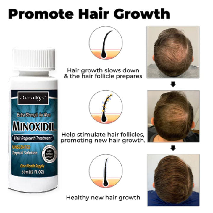 Oveallgo™ Minoxidil Hair Regrowth Treatment